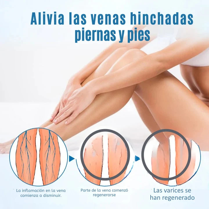 VARICOSE SPRAY® - Piernas más bonitas, Saludables y sin Complejos. Pague 1 LLeve2 - Ovykom 