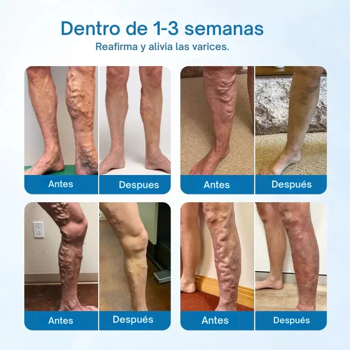 VARICOSE SPRAY® - Piernas más bonitas, Saludables y sin Complejos. Pague 1 LLeve2 - Ovykom 